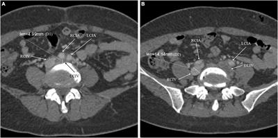 The association between iliac vein compression degree and characteristics of first diagnosed left lower extremity deep vein thrombosis